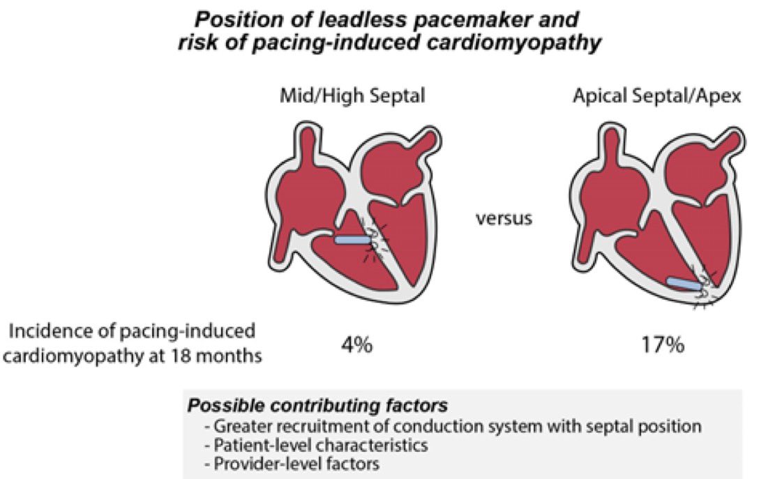 JMannisi's tweet photo. Optimal implant location for a #leadlesspacemaker may also be high septum, left bundle to reduce risk of developing cardiomyopathy. An opportunity to design sheath for optimal delivery.
Anatomical location of leadless pacemaker and the risk of pacing‐induced cardiomyopathy
https://t.co/fhdAP2vx49