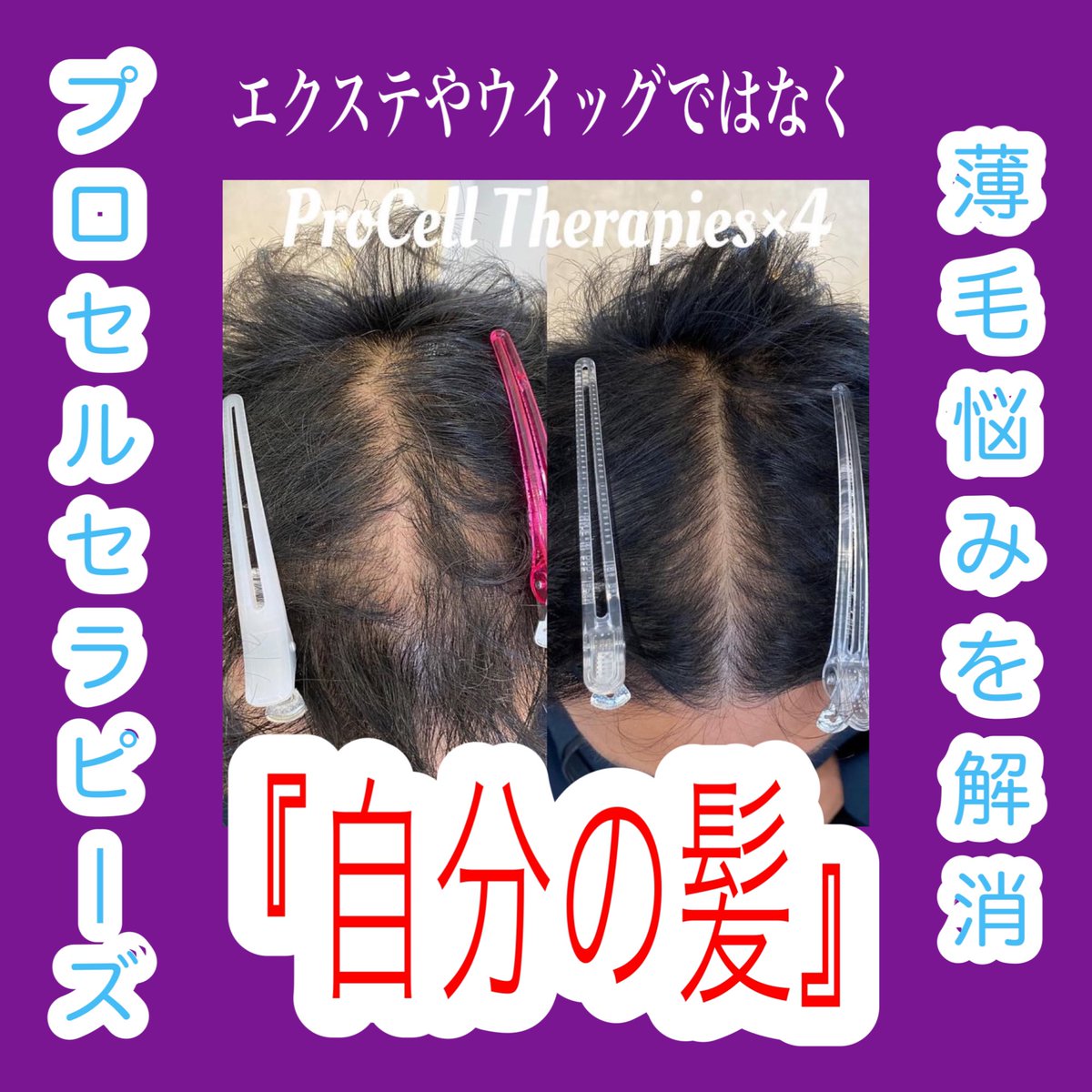 プロセルセラピーズ本体 プロセルセラピーズ Procell therapies! アメリカ皮膚科医が開発した