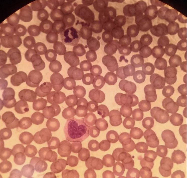 NicoGagelmann's tweet photo. Patient with fatigue. Diagnosis? https://t.co/l0SHKJG1s1
