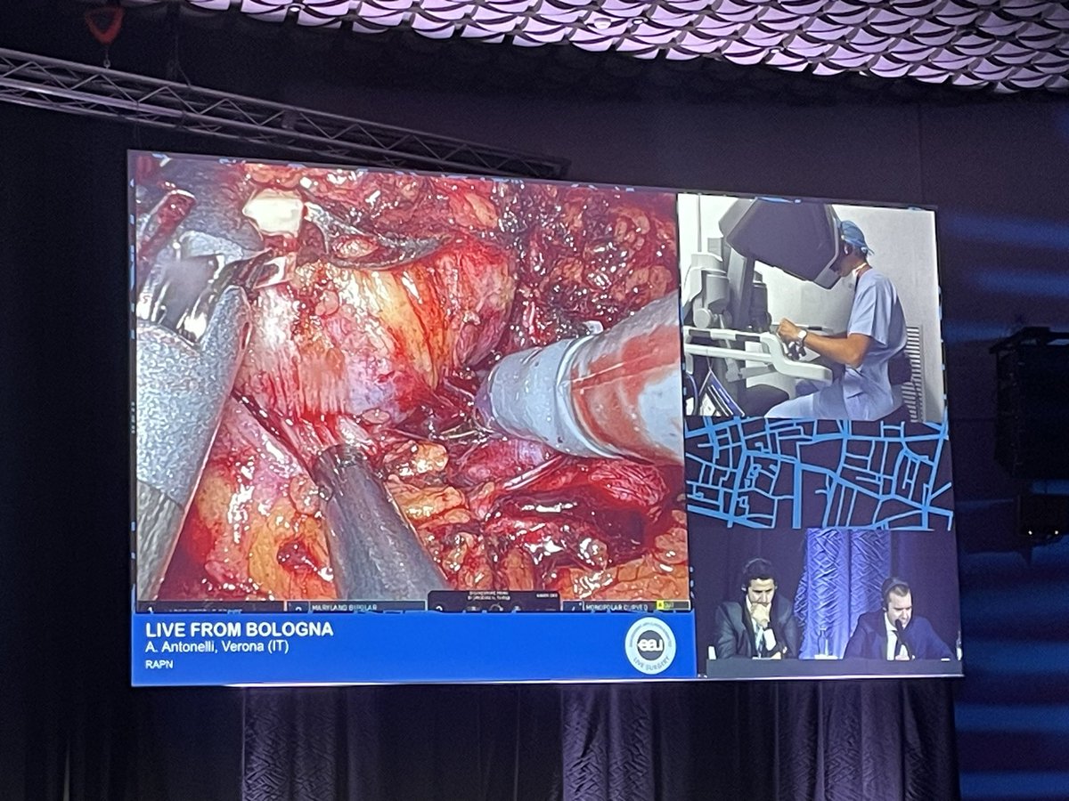 RicBertolo's tweet photo. Live case by @aleantonellibs1 at #ERUS23, performing #RAPN of 2 synchronous masses.
Nice demonstration of the subtle difference between #enucleation vs #enucleoresection.
Such case witnessed how an #anatomical #resection #technique helps in detecting initial tumor #venotropism. https://t.co/6SgtM38TA5