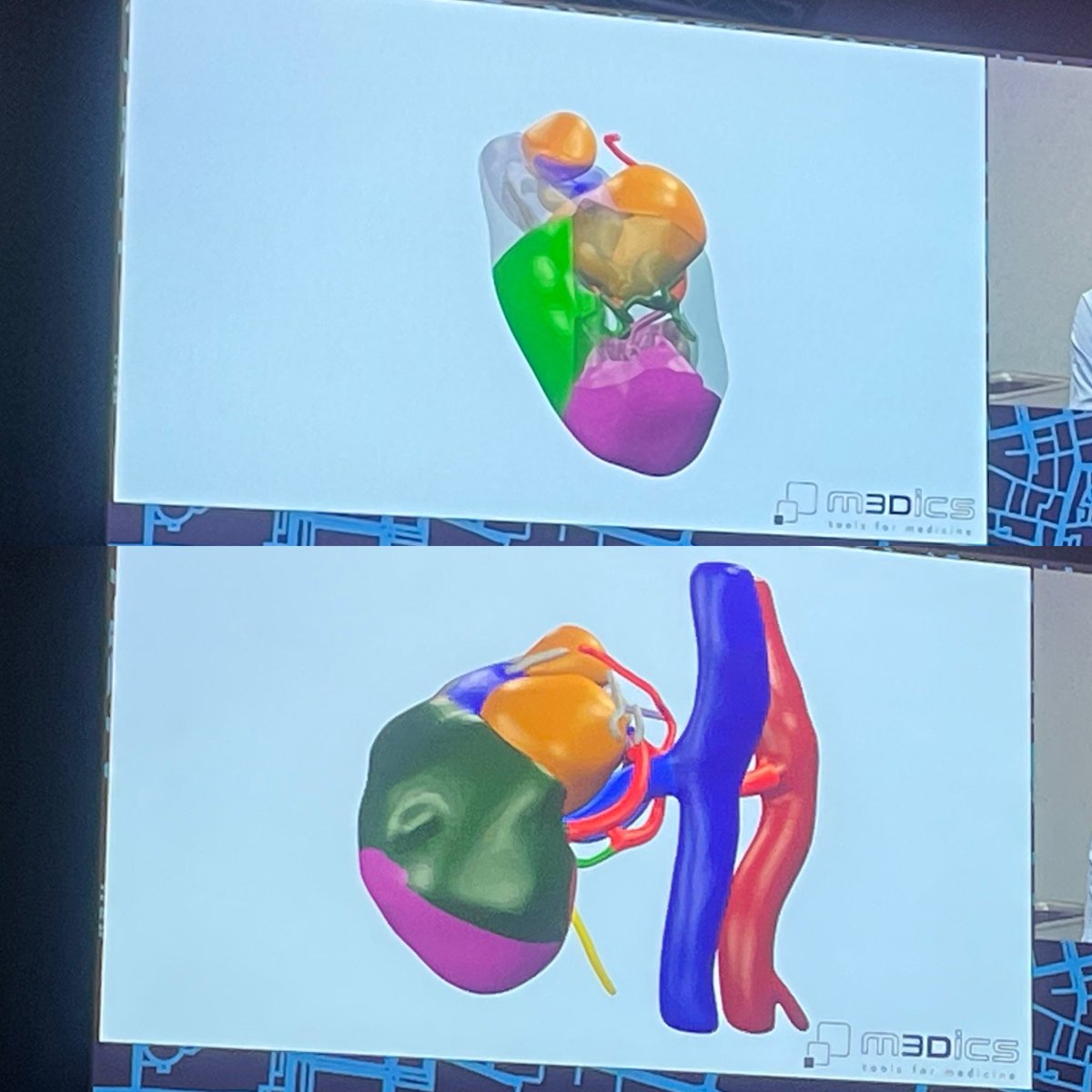 RicBertolo's tweet photo. Live case by @aleantonellibs1 at #ERUS23, performing #RAPN of 2 synchronous masses.
Nice demonstration of the subtle difference between #enucleation vs #enucleoresection.
Such case witnessed how an #anatomical #resection #technique helps in detecting initial tumor #venotropism. https://t.co/6SgtM38TA5