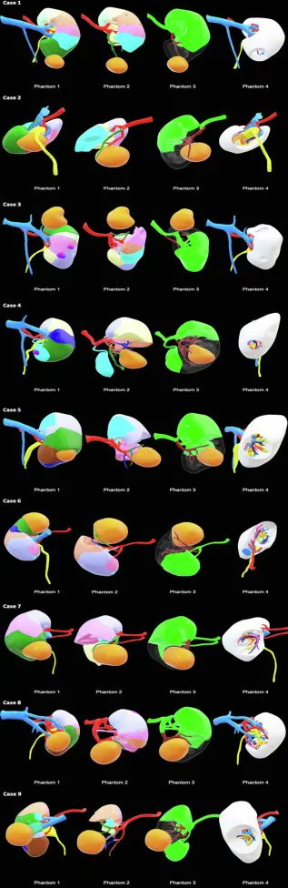 Articles in Press: Metaverse Surgical Planning with Three-dimensional Virtual Models for Minimally Invasive Partial Nephrectomy  buff.ly/45K3Nr2