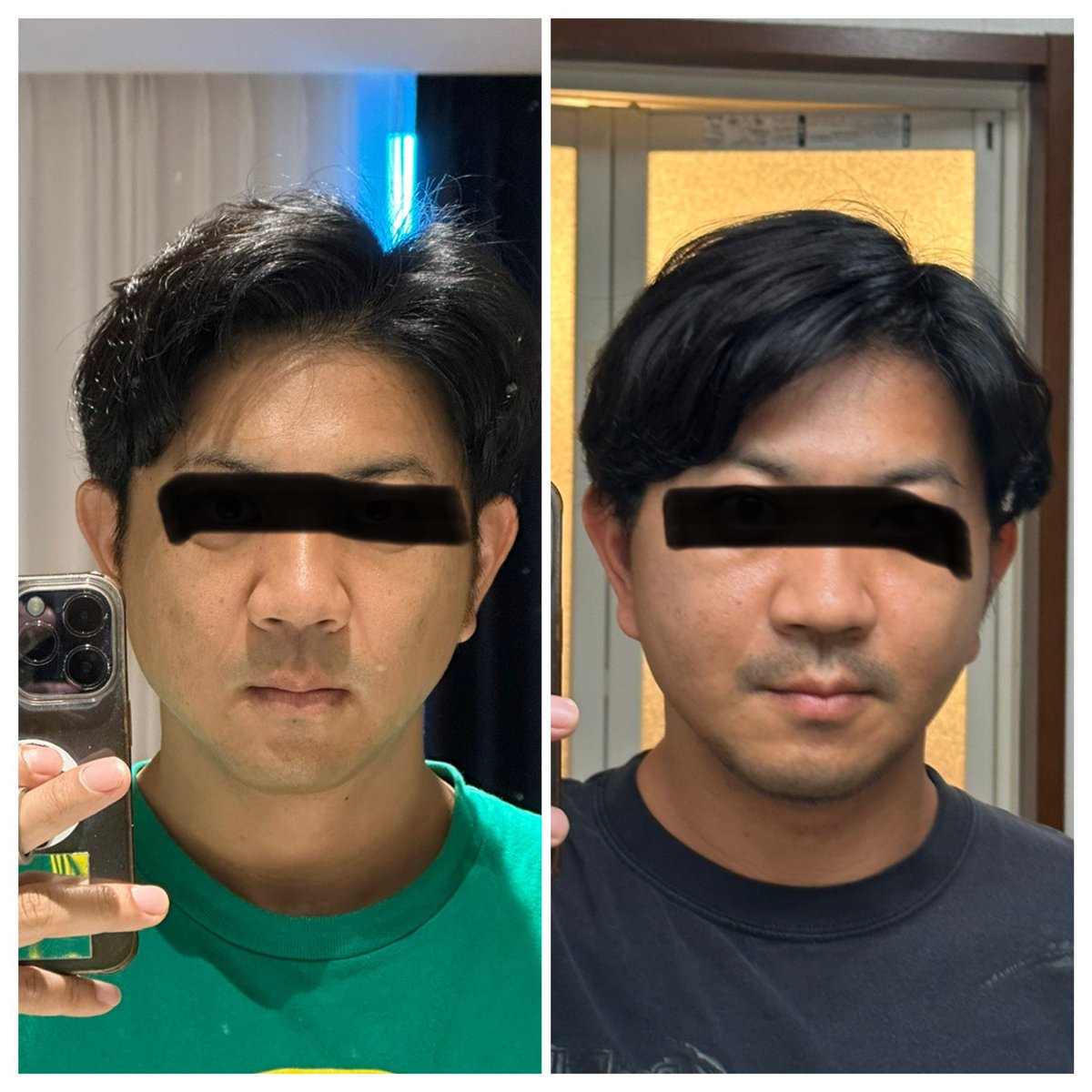 切開リフトDT10日目

ビフォーアフターです。

まだ腫れてきますので、単純に比較できませんが、今もずっと引き上げられてます

顎下は今でもかなり変化を感じてます

#rex 
#切開リフト 
#バッカルファット 
#メーラーファット
#整形垢 
#韓国 
#整形
#ANA
#voco
#ダウンタイム
#メンズ美容