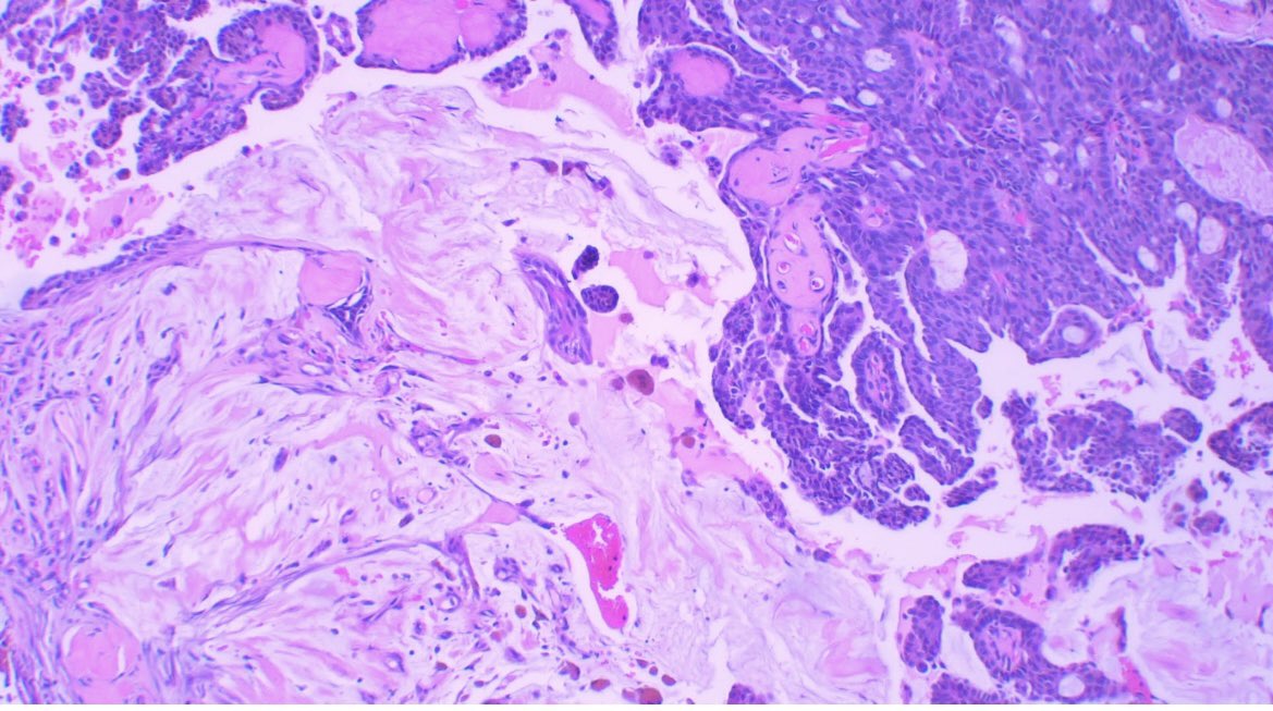 Endocrine mucin-producing sweat gland carcinoma Elderly patients Eyelids and periorbital skin Nodule/papule Well-demarcatec expansive nodules with cystc, papillary and solid architecture. #path #pathology #PathTwitter #dermatology #dermpath #skin #derm #medtwitter