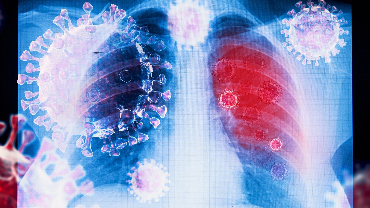 AASMorg's tweet photo. #BMCPulmonaryMedicine study findings reveal that patients with #SleepApnea are at increased risk of being diagnosed with a lower respiratory tract infection within but not beyond one year before and after diagnosis of sleep apnea. https://t.co/CbbEQEsEKD https://t.co/Dm5TWxu5NP