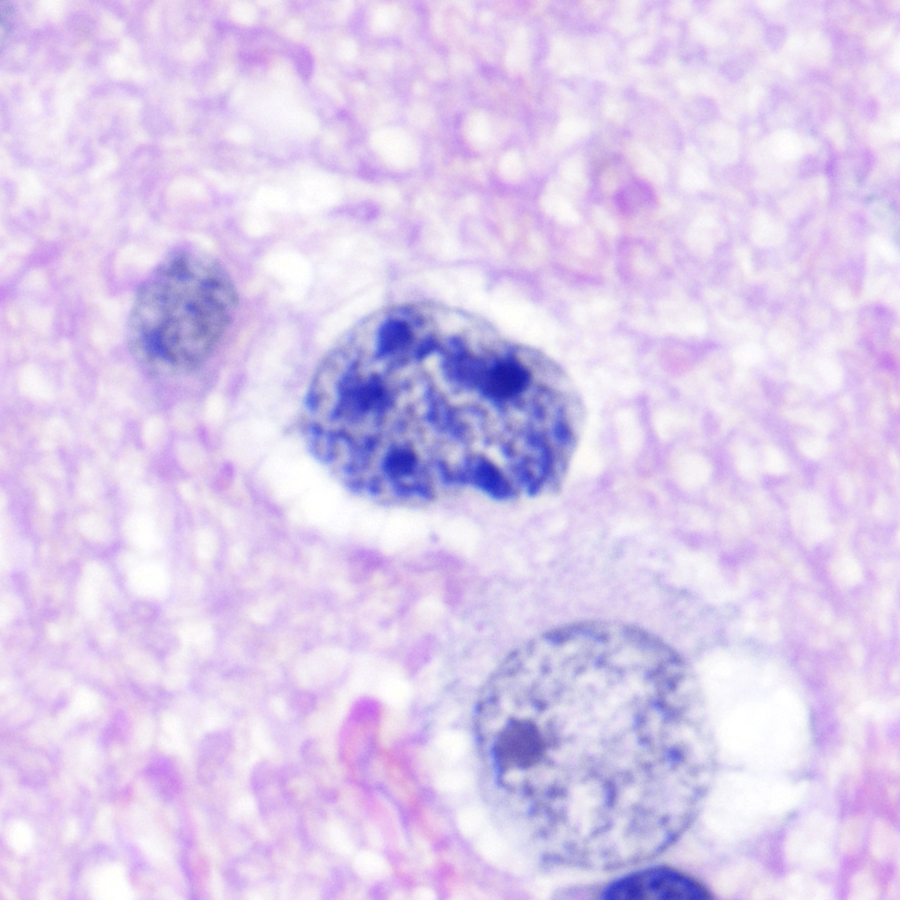 Funky chromatin pattern in this #glioblastoma cell adjacent to a #neuron, courtesy of @najemhinda
#pathology #neuropath #PathTwitter