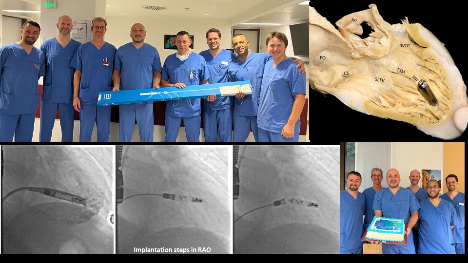 First implant of the new leadless PM by @AbbottCardio. Thanks to the team of @HdzNrw - great result. Looking forward to the first 'real' dual chamber devices.... @YoungDgk @AGEP_DGK @GuramImnadze @chris_sohns @melhamriti @MBraunEP