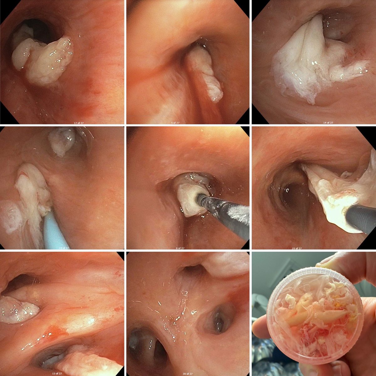 DocAbedi's tweet photo. Unicorns masquerading as zebras! Plastic Bronchitis previously misdiagnosed as PAP.
Dx confirmed by bronchoscopy and lymphoscintigraphy.
Tx with VV-ECMO supported airway clearance with rigid forceps, cryoprobe, fogarty baloon, and pending lymphatic embolization. 
With @pulmo_dok https://t.co/lZHB4dFiYc