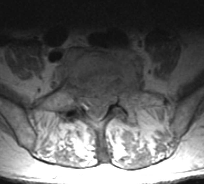 #CaseOfTheWeek ‼️🥳‼️

☢️🩻☠️Case#37☠️🩻☢️ 

#BackPain

➡️➡️📲#Diagnosis❓❔❓🎒

#FOAMrad #RadEd #OrthoTwitter <a href="/ssr_rwg/">SSR_RWG</a> @UWRadRes #MedEd #OrthoSpine <a href="/NASSspine/">NASS</a>