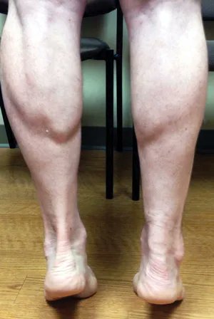 My thinking for a long while has been that the Achilles, and most other tendons AND the ACL have tissue degradation prior to rupture. Next paper says not always. But, teams should be regularly screening players for this. There are even steps to take to screen before imaging.