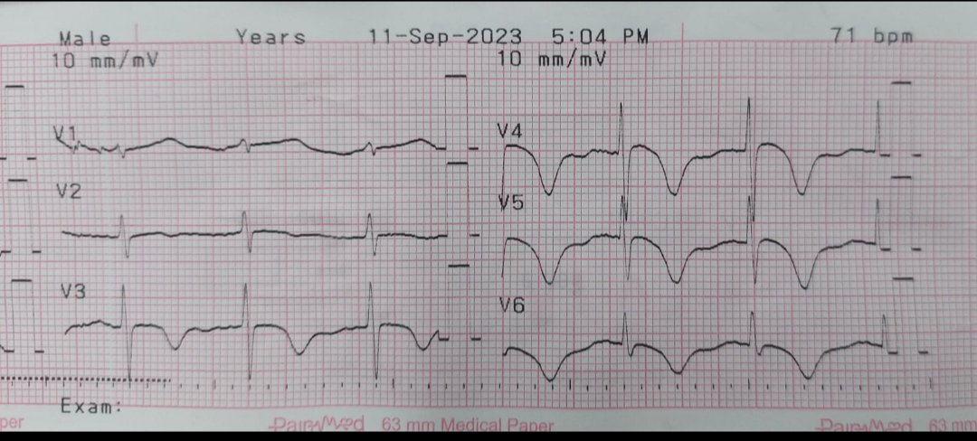 HemodinamiaNews's tweet photo. Fem patient, 88 years old, with #NSTEMI KK I, hemodynamically stable. #multivessel disease
#octogenarian #radialfirst
@robertoccorrea https://t.co/Pte9vwF6w9