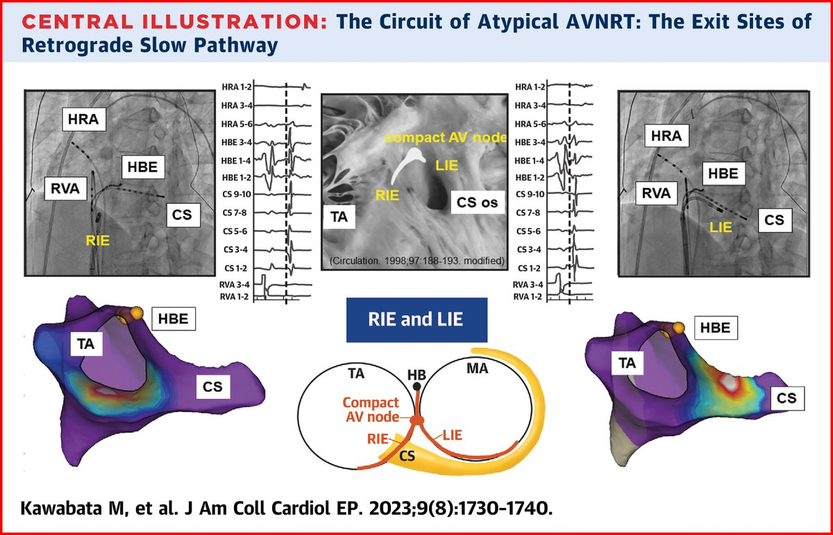 Arash Arya (@arasharya_ep) on Twitter photo #EPeeps
Paradigm Shift for Catheter Ablation of Atypical AVNRT: 3D Mapping–Based Ablation. jacc.org/doi/10.1016/j.…
<a href="/SeddingUni/">Univ.-Prof. Dr. med. Daniel G. Sedding</a> <a href="/GerdHindricks/">Gerhard Hindricks</a> <a href="/Phiso_de/">Philipp Sommer</a> <a href="/DinovBorislav/">BorislavDinov</a> <a href="/SergioRichterMD/">Sergio Richter</a> <a href="/chris_sohns/">Christian Sohns</a> <a href="/JoernTongers_MD/">Jörn Tongers</a> <a href="/Dr_Santangeli/">Pasquale Santangeli</a> <a href="/MRazminia/">Mansour Razminia</a> <a href="/Hapa_EP/">Kevin Brady</a> <a href="/shivkumarmd/">Kalyanam Shivkumar MD PhD</a> <a href="/ShaojieChen1/">Shaojie Chen</a> #EPeeps
Paradigm Shift for Catheter Ablation of Atypical AVNRT: 3D Mapping–Based Ablation. jacc.org/doi/10.1016/j.…
<a href="/SeddingUni/">Univ.-Prof. Dr. med. Daniel G. Sedding</a> <a href="/GerdHindricks/">Gerhard Hindricks</a> <a href="/Phiso_de/">Philipp Sommer</a> <a href="/DinovBorislav/">BorislavDinov</a> <a href="/SergioRichterMD/">Sergio Richter</a> <a href="/chris_sohns/">Christian Sohns</a> <a href="/JoernTongers_MD/">Jörn Tongers</a> <a href="/Dr_Santangeli/">Pasquale Santangeli</a> <a href="/MRazminia/">Mansour Razminia</a> <a href="/Hapa_EP/">Kevin Brady</a> <a href="/shivkumarmd/">Kalyanam Shivkumar MD PhD</a> <a href="/ShaojieChen1/">Shaojie Chen</a>