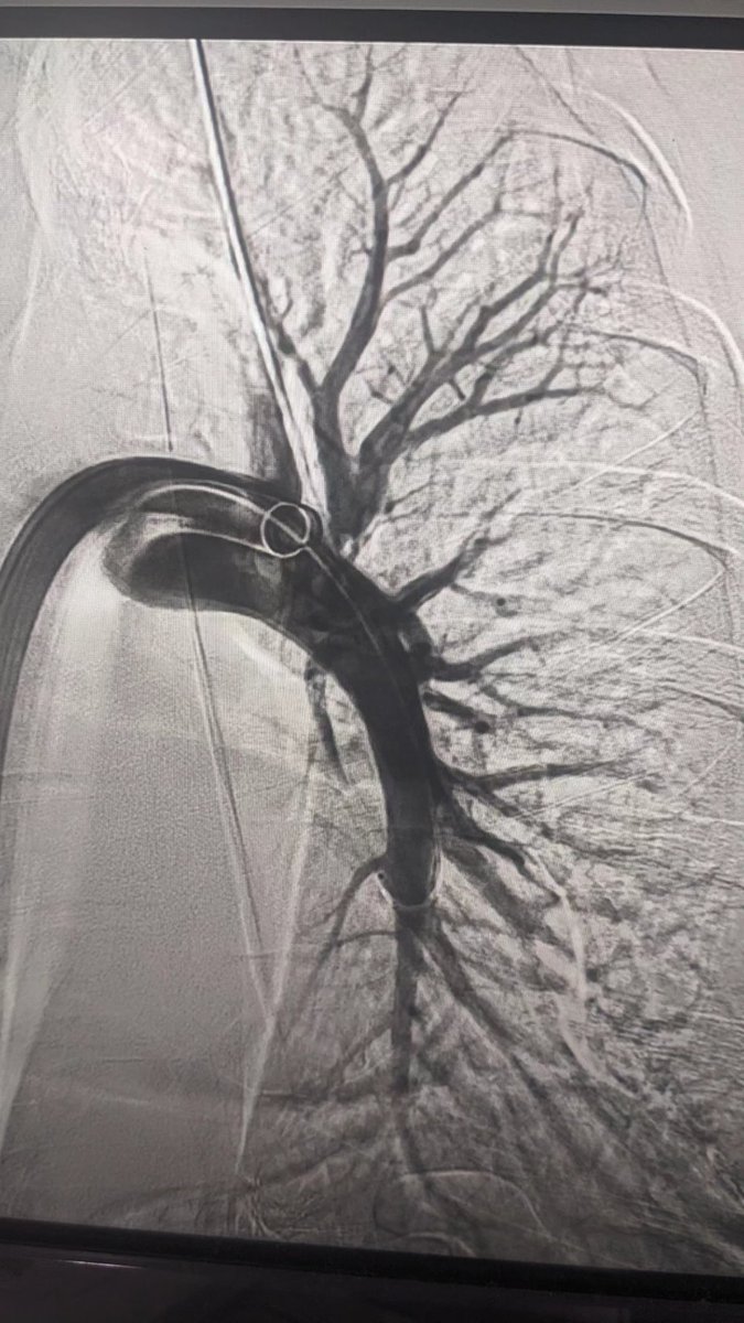 barillas_irene's tweet photo. Immense respect for the Interventional folks! I do❤️ good results @ffr81 amazing results! WiC 🫁🫀💃 https://t.co/R5lx3Mfbrs