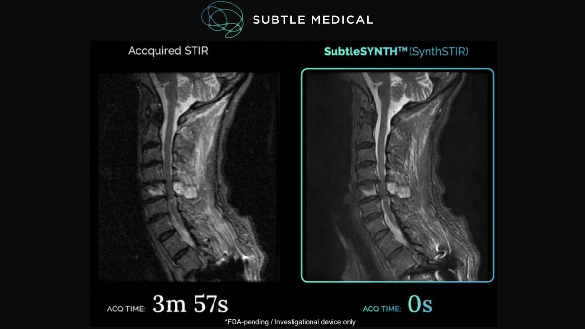 Subtle Medical, Inc. (@subtlemedical) on Twitter photo Big News! šThrilled to share that <a href="/SubtleMedical/">Subtle Medical, Inc.</a> has been awarded a $2.3M #NIH Grant to advance our synthetic imaging technology #SubtleSYNTH! Read more: bit.ly/4622IL2
š Join our webinar next week to learn how itās transforming MRI practices. RSVP now, link in Big News! šThrilled to share that <a href="/SubtleMedical/">Subtle Medical, Inc.</a> has been awarded a $2.3M #NIH Grant to advance our synthetic imaging technology #SubtleSYNTH! Read more: bit.ly/4622IL2
š Join our webinar next week to learn how itās transforming MRI practices. RSVP now, link in