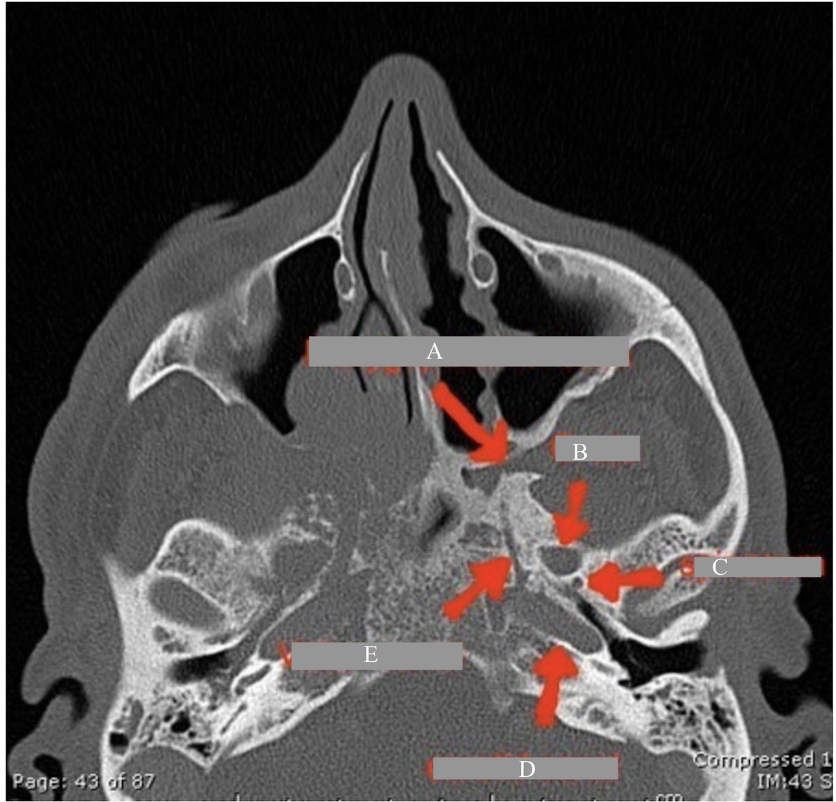 Lets Review! Can u name following landmarks shown by  arrows on this non-contrast sinus CT (axial view)? Extra cred if name structures contained by each--Retweet/share, I'll post answer later! #headnecksurgery #medtwitter #radiology #sinussurgery #surgery #rhinology #neurosurgery