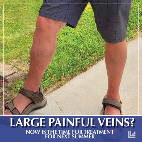 Don't let those pesky veins hold you back from feeling your best! Schedule a consultation with us today and let's work on getting your legs ready for next summer. ☀️ 👍
Call us at 636-614-1665 to schedule a free visit today!

#LLVC #VeinTreatment #VeinDisease