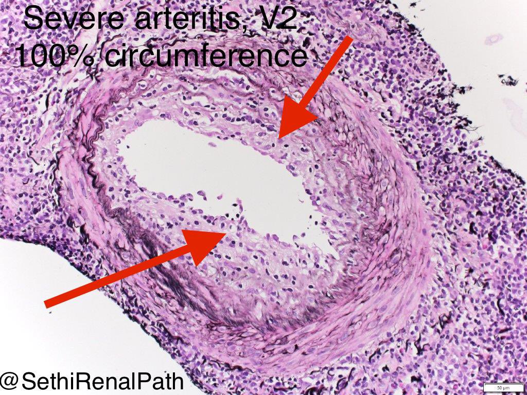 SethiRenalPath's tweet photo. Good teaching case today.

Severe arteritis, with large # lymphocytes under endothelial cells

Arteritis, involves entire 100% circumference=V2 lesion

V2=>25% per criteria

Dx:Acute cell mediated rejection, Banff 2B

C4d neg

45 yr old 1 month post transplant ⬇️immunosuppression https://t.co/13Lr1FGIPd