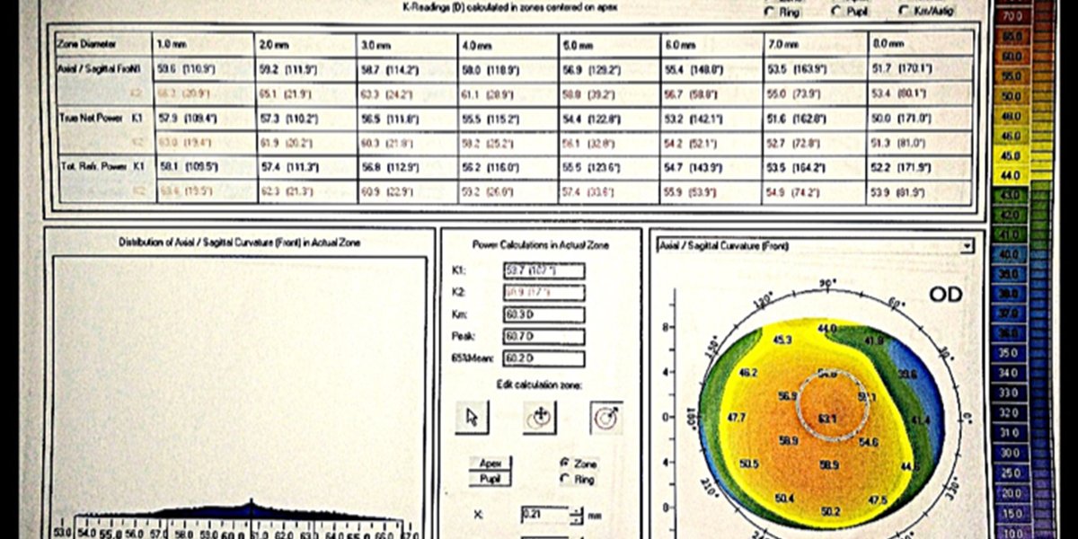 eyewiki's tweet photo. Planning for #cataractsurgery in a patient with known corneal #ectasia? Learn how to select the best lens. #ophthalmology https://t.co/CSVmgtuOKT https://t.co/ZyxkBqYClr
