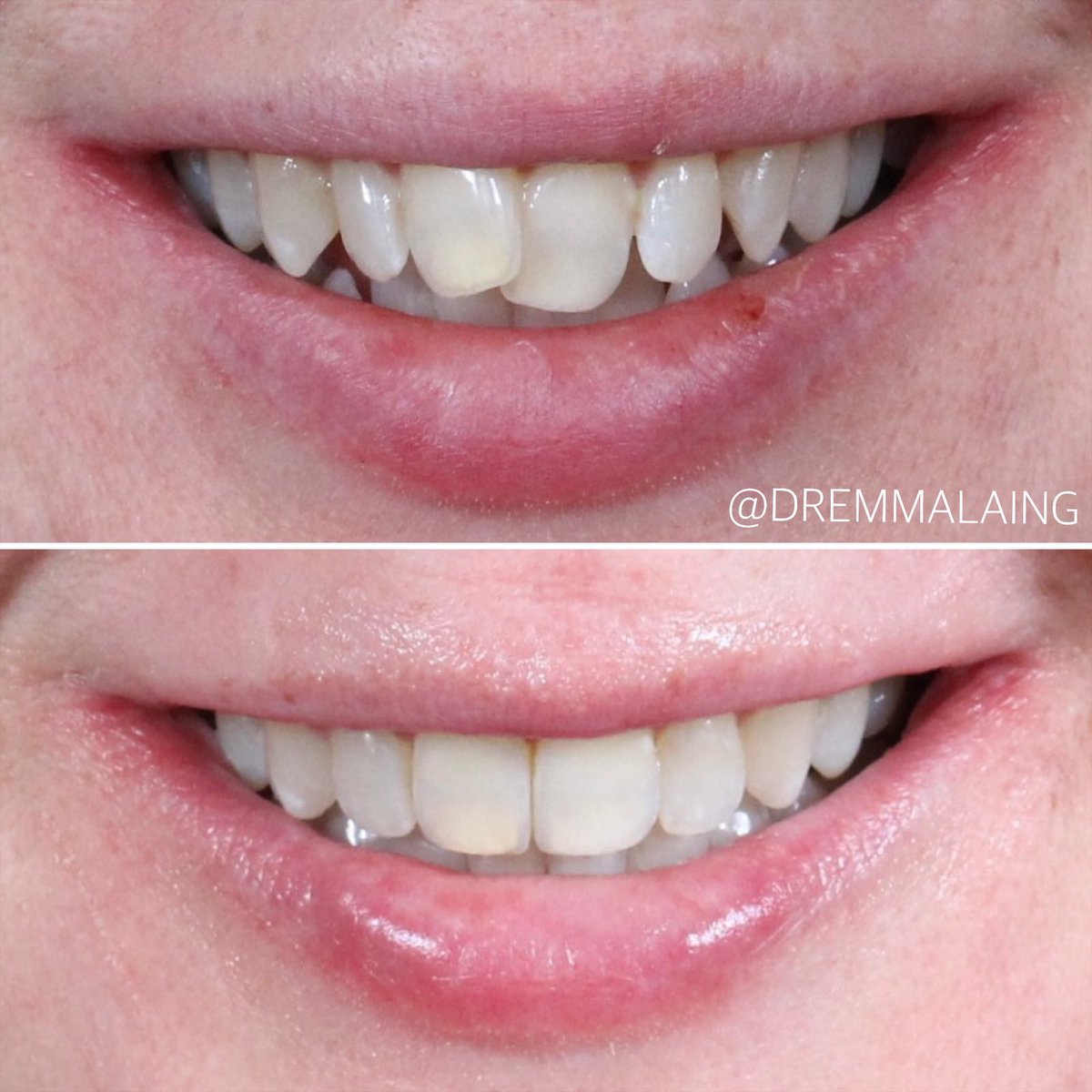 dremmalaing's tweet photo. When this lady came to see me she held her hand over her teeth for the 60mins consultation and was in tears recounting the cruel comments she had had about them and she felt nothing could be done. It has been beyond rewarding to be able to help her with just orthodontics https://t.co/crdMNpIEhR