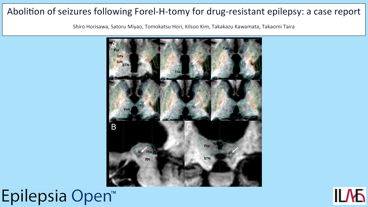 SHORT RESEARCH ARTICLE doi.org/10.1002/epi4.1… #pallidothalamictract #ForelHtomy #radiofrequencyablation #drugresistant #seizures #epilepsy #epilepsyresearch #ILAE #openaccess