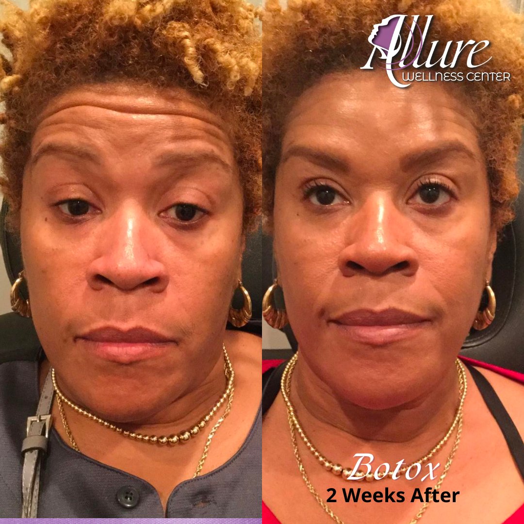 AllureLMedSpa's tweet photo. Botox results 2 weeks later...our same beautiful client with fewer forehead lines🤩

Schedule an appointment today. 📞l (708) 864-4988🏢 7151 183rd Street, Tinley Park, IL 60477⠀
https://t.co/fv4KBWYgsQ
#botox #injectables #neurotoxins #linesandwrinkles https://t.co/0QQxMZ0Y5Y