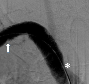 SeminarVascSurg's tweet photo. Major vascular traumas to the neck, upper limbs, and chest: Clinical presentation, diagnostic approach, and management strategies
More and more #vascular #trauma is being treated using an #endofirst approach. How do you do it?
https://t.co/1G5ncULU3A https://t.co/u4Weie6iYm