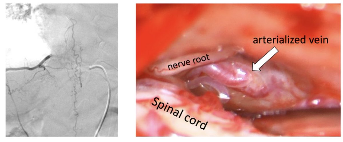 Not all spinal fistulas are CSF-venous fistulas. The OR was questioning why one of the fistulas we operated on yesterday required intra-op angiography. This was for a T10 dural arteriovenous fistula.