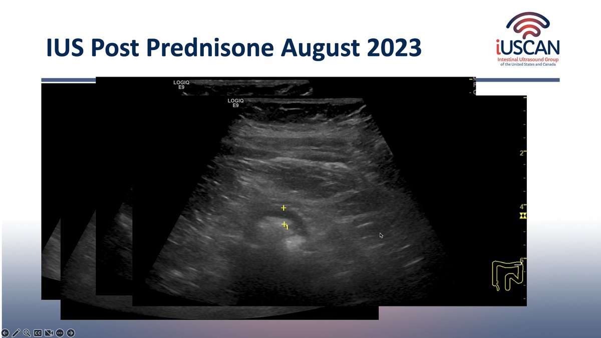 iUSCAN (@iuscan) on Twitter photo Fantastic cases yesterday from <a href="/yusukemiya73/">Yusuke Miyatani, MD</a> on how #IUS identified the need for dilation in a patient with obstruction and @drhughiefraser who showed that IUS predicts risk of flare despite improved symptoms (and can be helpful in non-compliant patients!) Fantastic cases yesterday from <a href="/yusukemiya73/">Yusuke Miyatani, MD</a> on how #IUS identified the need for dilation in a patient with obstruction and @drhughiefraser who showed that IUS predicts risk of flare despite improved symptoms (and can be helpful in non-compliant patients!)