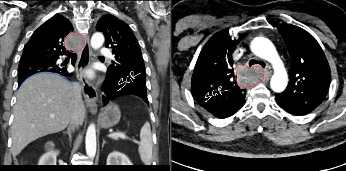 Right suprahilar/paratracheal opacity (red) with elevated right hemidiaphragm (blue), due to phrenic nerve palsy. CT to confirm. Port (yellow) was the clue for cancer.
This was metastatic squamous cell CA. #medtwitter #radiology #oncology #radres #chestrad