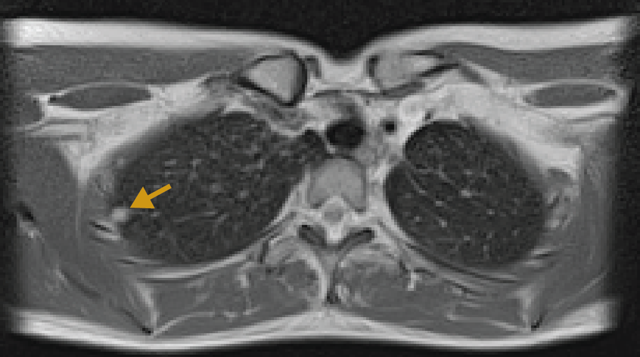 #DYK air in the body can distort #MRI images? Our #ImageOfTheWeek is look at a #LAM screening from @ACampbell_MRI of the NHLBI MRI Technology program. She uses low-field MRIs for improved image quality & lower radiation during. Learn more: go.nih.gov/CiQ2Xvp