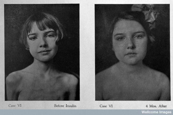 HISTORY

Before and After Insulin

This image was taken in 1922. The picture was published in the Journal of Metabolic Research. - Wellcome Trust

#T1D #Type1Diabetes #projectbluenovember