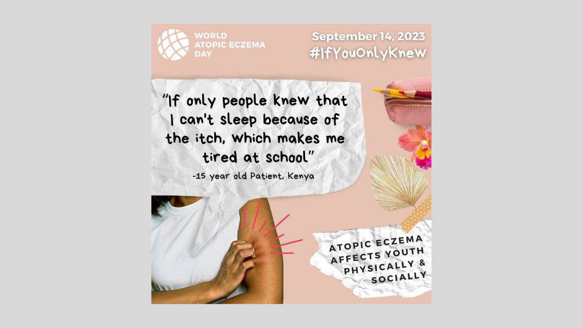 Around 95% of the TSW community comes from those who are diagnosed with eczema.  Join us for a webinar on the mental health impact of developing TSW from trusted medications used to treat eczema. 
Thursday, September 14
7:00pm-8:00pm EST
Learn more here: ow.ly/Tns150PJUoU
