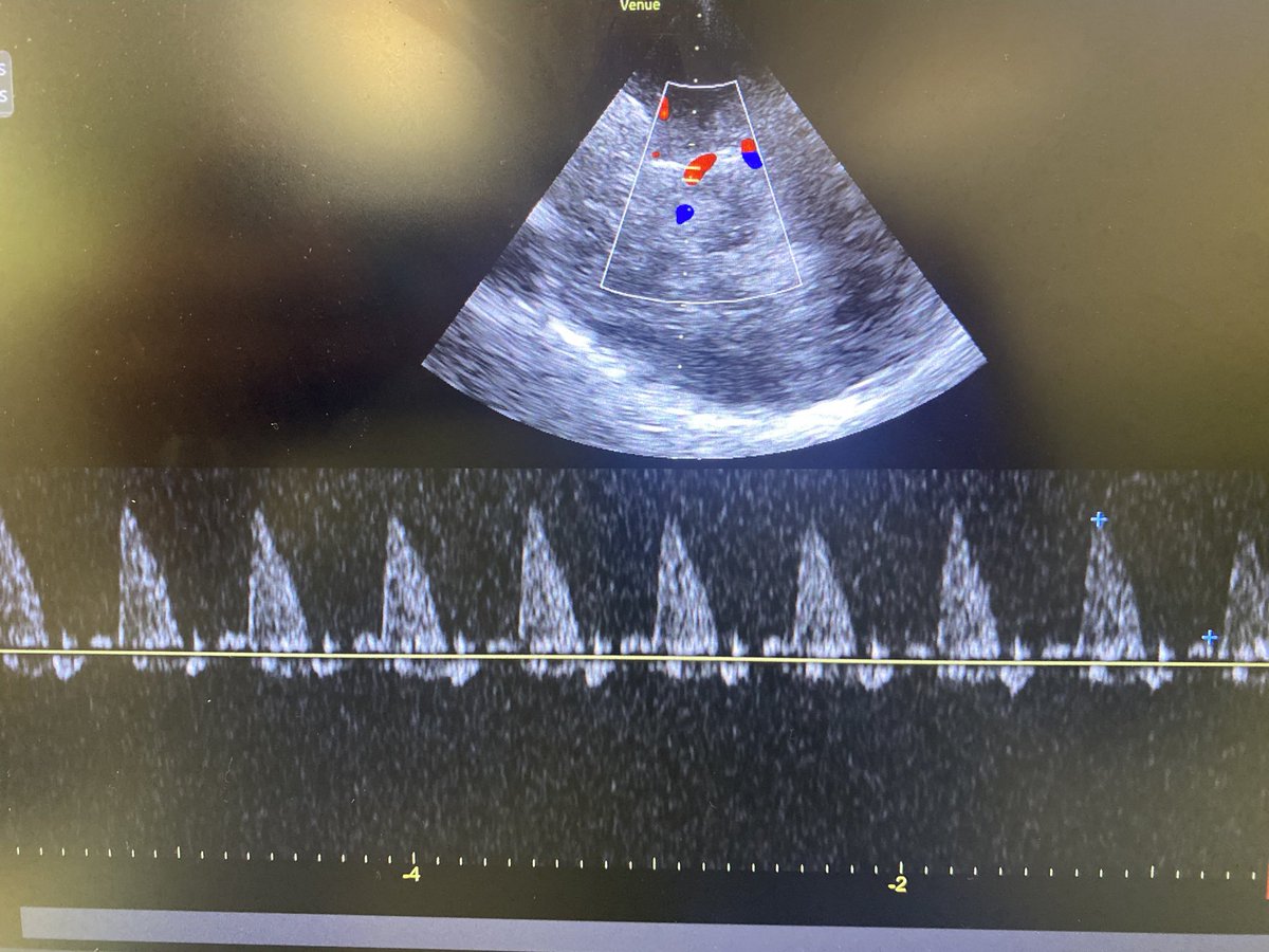 Philippe Rola (@thinkingcc) on Twitter photo Assessed a 50M w meningitis this am. Here was my neuropocus. Assessed a 50M w meningitis this am. Here was my neuropocus.