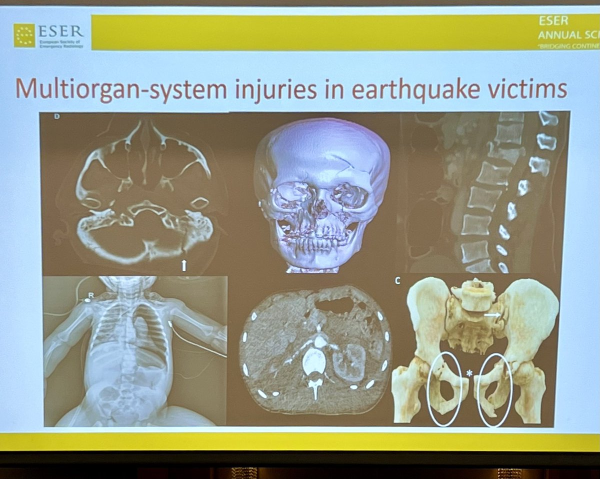 Imaging Findings from the Turkish Earthquakes by Dr. Ruhi Onur from #crush injuries <a href="/ruhionur/">ruhi onur</a> #ESER2023 <a href="/ESERadiology/">ESER</a>