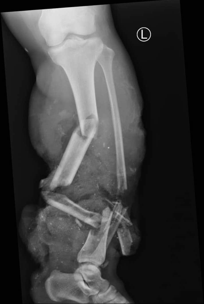 Alex Schade (@globalorthopod) on Twitter photo How much do people recover after severe motorcycle injuries in low-income countries (LICs)? 🏍️💥
This prospective cohort <a href="/TITAN_study/">TITAN study</a> of adults with open tibia fractures 🦴 from Malawi🇲🇼 published <a href="/LancetGH/">The Lancet Global Health</a> found substantial disability🩼 at 1 year t.ly/mg-TT 1/12 🧵 How much do people recover after severe motorcycle injuries in low-income countries (LICs)? 🏍️💥
This prospective cohort <a href="/TITAN_study/">TITAN study</a> of adults with open tibia fractures 🦴 from Malawi🇲🇼 published <a href="/LancetGH/">The Lancet Global Health</a> found substantial disability🩼 at 1 year t.ly/mg-TT 1/12 🧵