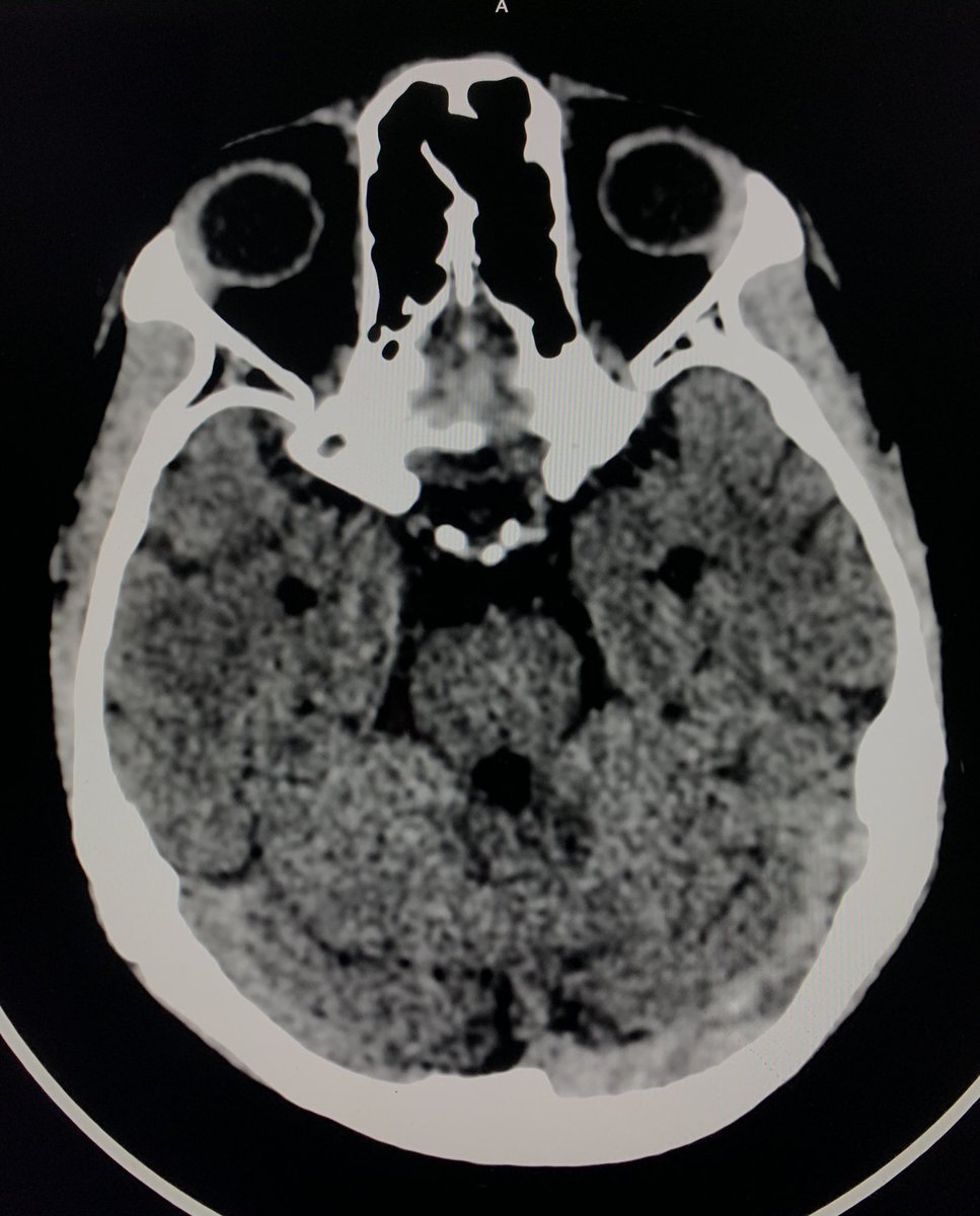 15 Yr old boy was referred for CT Brain from Nephrology department in view of recent onset(4 days) holocranial headache.
Why did I want to connect with the referring physician immediately after seeing these ? 

#Neurotwitter 
#Neurorad
#MedTwitter 
#Nephrology 
#FOAMed