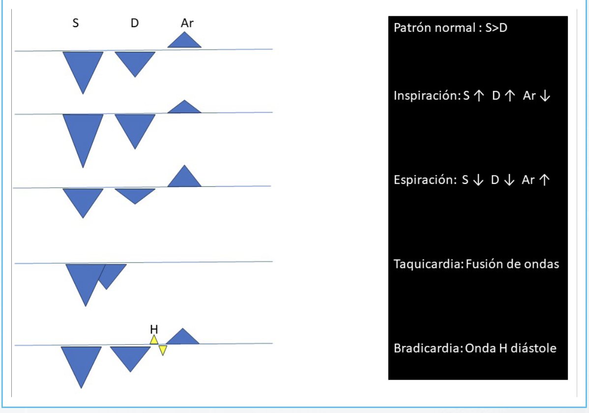 MAecocardio's tweet photo. Este práctico esquema te resume las variantes con Doppler del flujo de vena cava superior NORMAL 
Si te quieres enterar mas, lee  el trabajo :Evaluación ecocardiográfica de la vena cava superior ,último número de RETIC. 2023 Aug; 6 (2): 67-7 @mariovar55 
Aqui tiene es enlace:https://t.co/WoKFJPE4d9