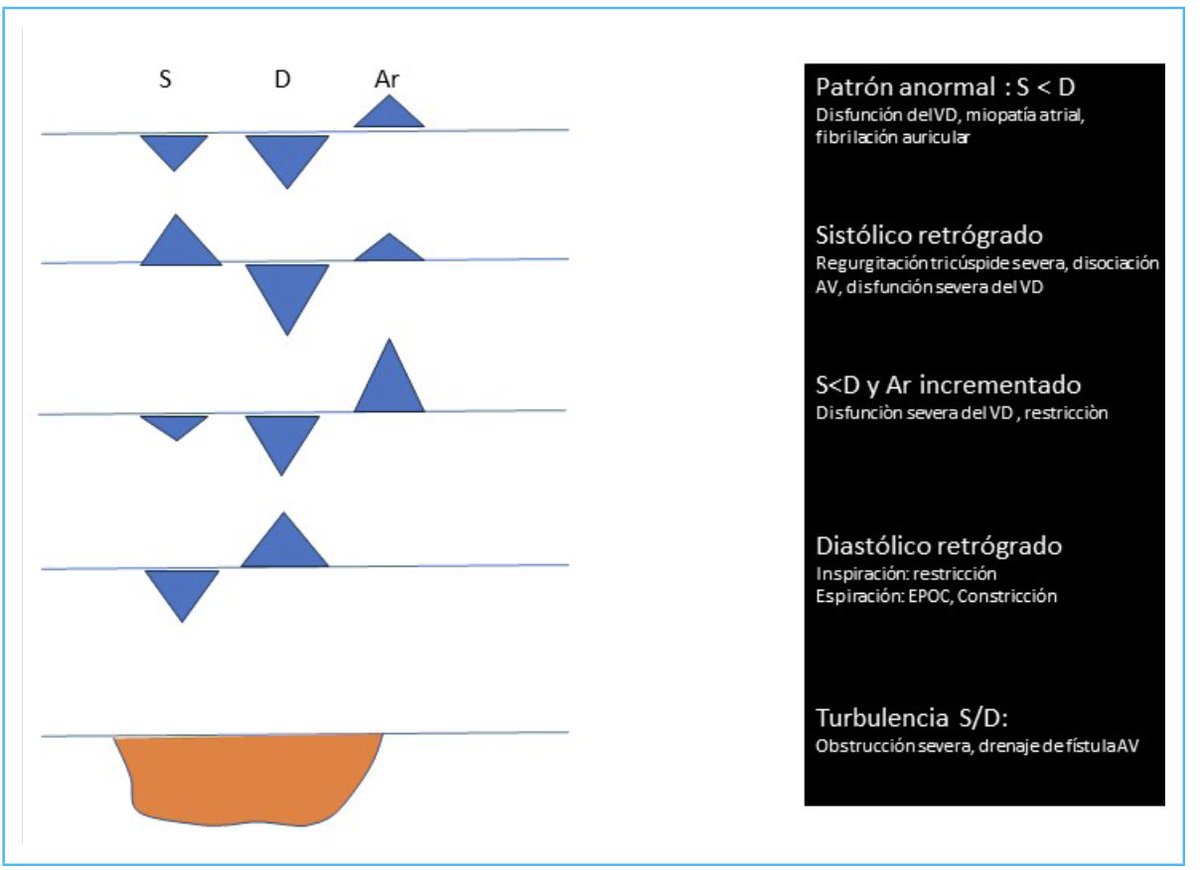 MAecocardio's tweet photo. Variantes PATOLOGICAS  con Doppler del flujo de vena cava superior 
 :Evaluación ecocardiográfica de la vena cava superior ,último número de RETIC. 2023 Aug; 6 (2): 67-7 @RevistaRetic 
de @mariovar55
https://t.co/tBxorBKVD1 https://t.co/qvNRfvbiS2