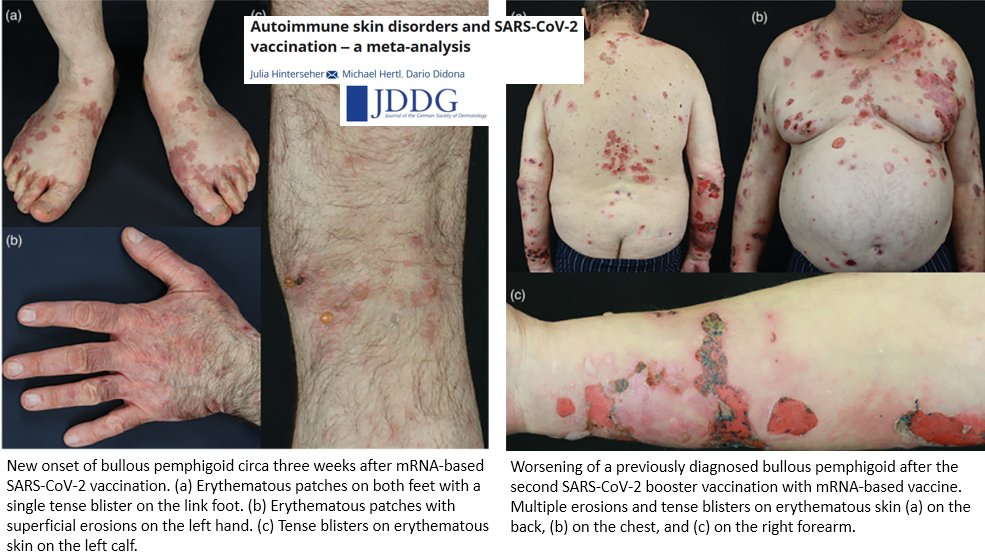 DrJohnB2's tweet photo. "Our meta-analysis highlights a link between #COVID vaccination &amp; new onset or worsening of inflammatory &amp; autoimmune skin diseases" https://t.co/muaU4Qg4h1

"The real number of new onset or worsening of autoimmune skin diseases after SARS-CoV-2 vaccination may be underestimated" https://t.co/YnU7bLeNd2