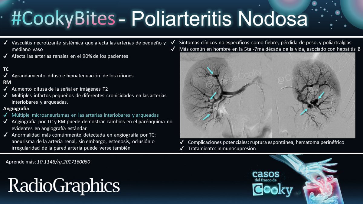 Casos de Cooky (@casoscooky) on Twitter photo Respuesta: Poliarteritis Nodosa
Aprende más: doi.org/10.1148/rg.201…
Traducido por: <a href="/CBarreraMD/">Christian Barrera, MD</a>
#CasosCooky #82 #CookyBites #RGphx <a href="/cookyscan1/">Cooky Menias</a> <a href="/RadioGraphics/">RadioGraphics</a> Respuesta: Poliarteritis Nodosa
Aprende más: doi.org/10.1148/rg.201…
Traducido por: <a href="/CBarreraMD/">Christian Barrera, MD</a>
#CasosCooky #82 #CookyBites #RGphx <a href="/cookyscan1/">Cooky Menias</a> <a href="/RadioGraphics/">RadioGraphics</a>