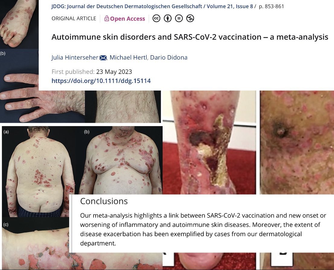 corona_realism's tweet photo. 🚨Aktuelle Meta-Analyse der Uniklinik Marburg anhand von rund 200 Studien zeigt Zusammenhang zwischen Covid-Impfung und autoimmunen Hauterkrankungen.

Veröffentlicht im Journal der Deutschen Dermatologischen Gesellschaft.
https://t.co/zFT8Hnx9Of https://t.co/ehUIELIqEj