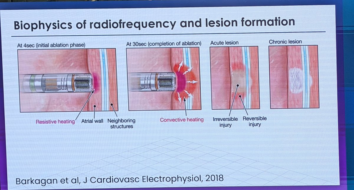 Dr. Jonathan Lipton (@epinnovation) on Twitter photo Prevention of reconnection by endocardial sparing: interlesion spacing no more than 5 mm, avoid CF >10g #aphrs2023 <a href="/dr_andien/">Dian Andina Munawar</a> Prevention of reconnection by endocardial sparing: interlesion spacing no more than 5 mm, avoid CF >10g #aphrs2023 <a href="/dr_andien/">Dian Andina Munawar</a>