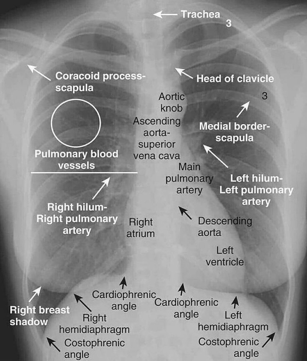 chest X-ray 

from William Herring/Learning Radiology #MedEd #MedTwitter
