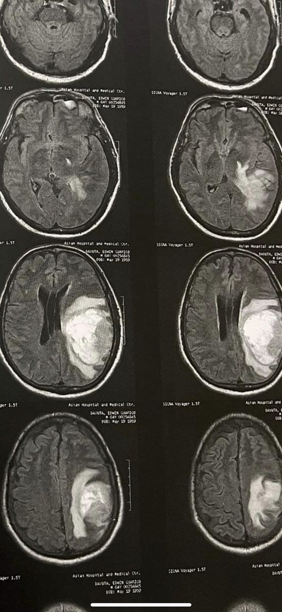 This growth happened in the span of approximately six weeks. He needs this surgery ASAP.

Please, if you can help, please consider helping my dad. Thank you. 🩵

justgiving.com/crowdfunding/J…