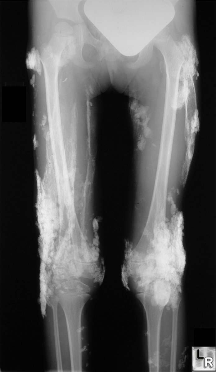 MoreXGrok's tweet photo. What's the most likely diagnosis?

A. Myositis ossificans

B. Venous insufficiency

C. Dermatomyositis

D. Sarcoid

(Source: LR) https://t.co/CRVAbYLkpd