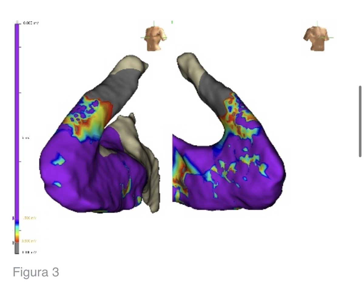 italian_cot's tweet photo. 💡🫀ICOT clinical case of the week 🫀💡
💡Tachicardia ventricolare da RVOT: il mappaggio elettroanatomico tridimensionale come chiave per la diagnosi differenziale tra forma idiopatica e cardiomiopatia aritmogena del ventricolo destro.

📌 https://t.co/69pWyBZMF0 https://t.co/iugWVkmIxZ