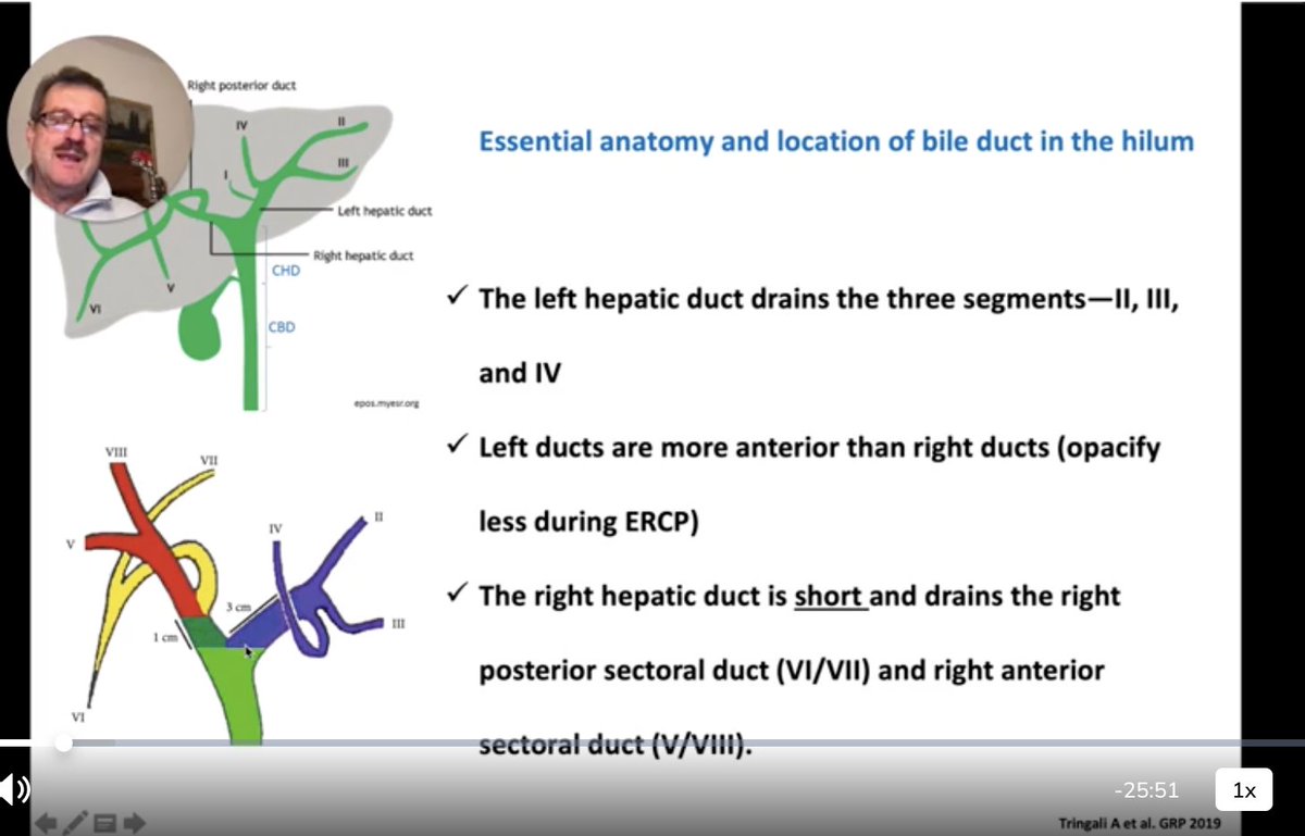 EndoCollabcom's tweet photo. Understanding the anatomy of the bile duct is essential for successful stone removal

The successful removal of bile duct stones relies on knowing the anatomical aspects of the bile ducts, including their segments and drainage patterns.

For example: the left hepatic duct is located more anteriorly than the right hepatic ducts, making cannulation of the right hepatics easier.

It is also important to obtain contrast or cholangiograms of the left system, which can be more challenging.

Knowing these anatomical details helps in planning the removal procedure effectively.