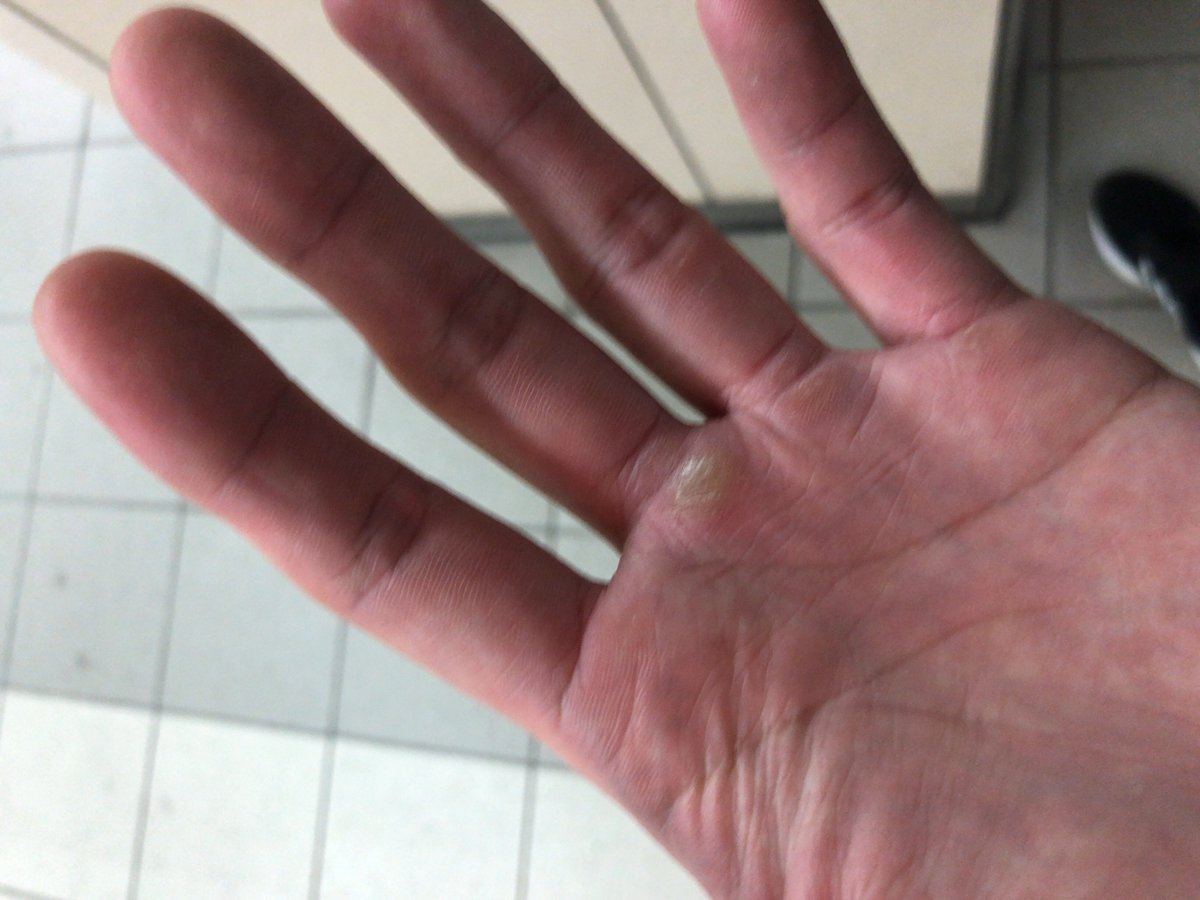 hiroya1016D's tweet photo. デッドリフトあるある。

手の豆がやばい。

#筋トレ https://t.co/LxXKqsuAdz