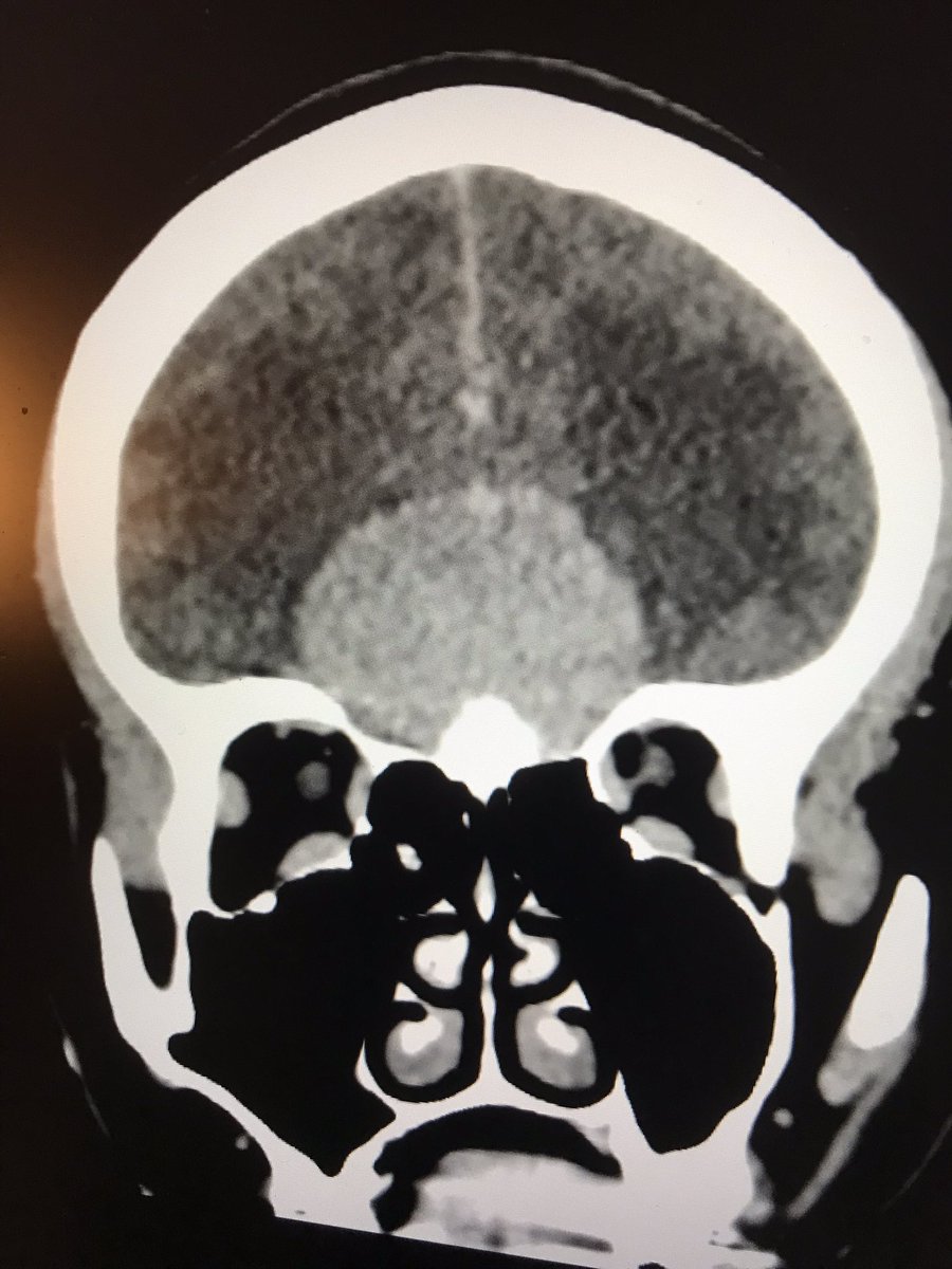 duvivierfloren2's tweet photo. #scanner #malaises
F jeune
À éviter :
-Pour le Radiologue : « les structures de la ligne médiane sont en place »
–Pour la patiente : se faire suivre par un mauvais ostéopathe pour des hypoglycémies 😬 https://t.co/lgMaKZj25Q