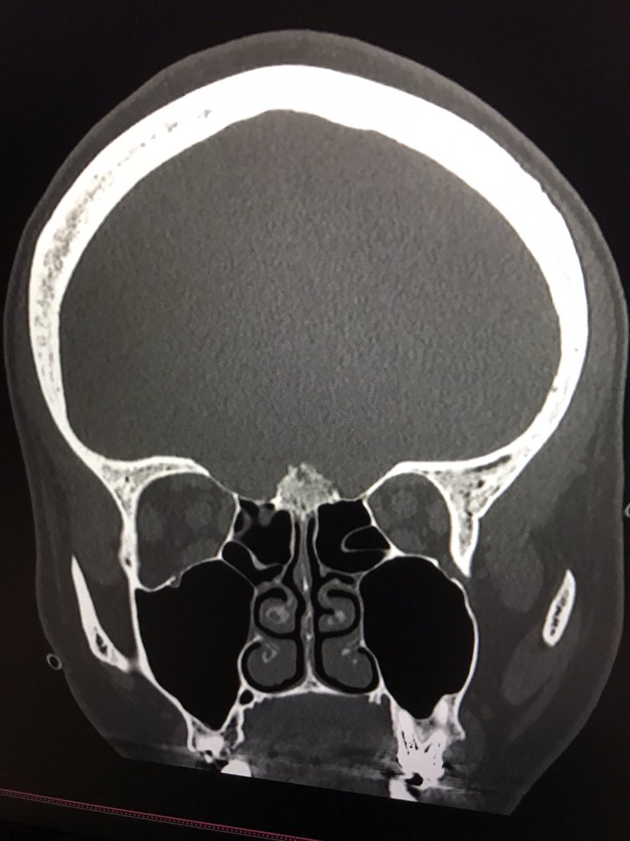 duvivierfloren2's tweet photo. #scanner #malaises
F jeune
À éviter :
-Pour le Radiologue : « les structures de la ligne médiane sont en place »
–Pour la patiente : se faire suivre par un mauvais ostéopathe pour des hypoglycémies 😬 https://t.co/lgMaKZj25Q
